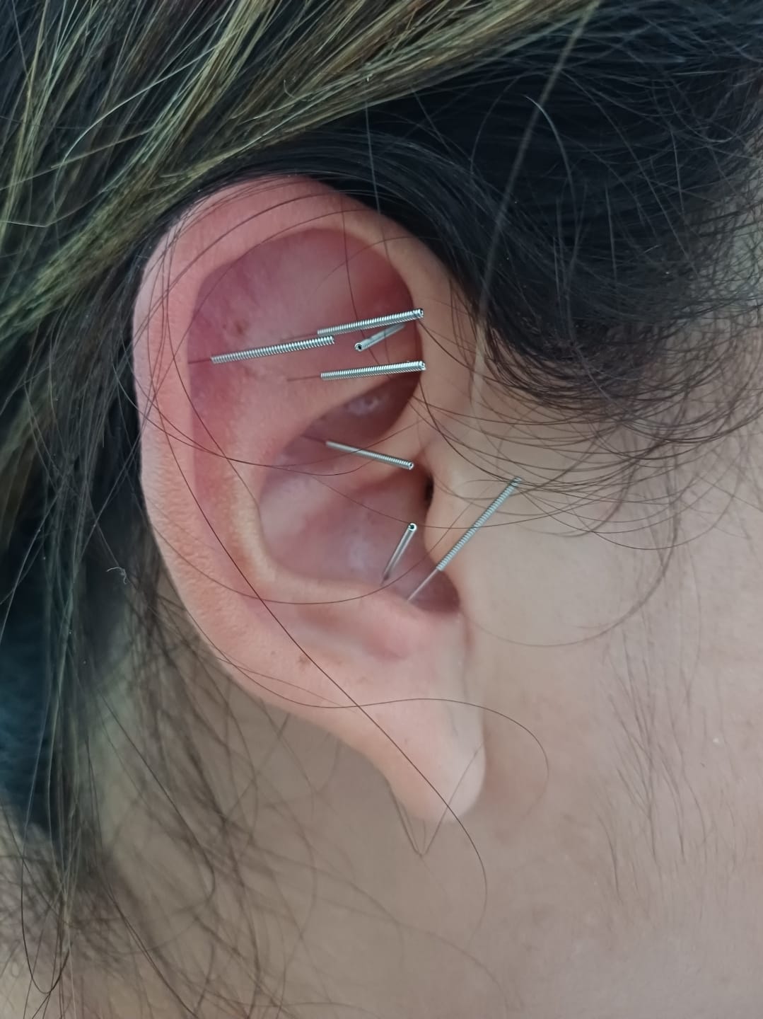 Sessão de auriculoterapia